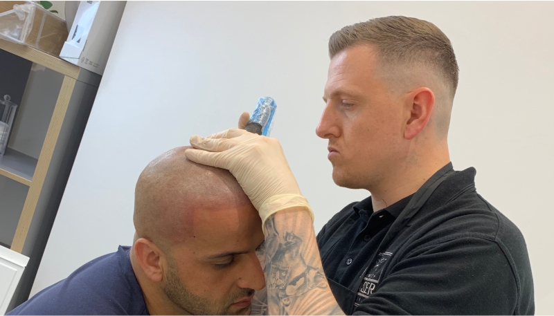 Devon Scalp Micropigmentation