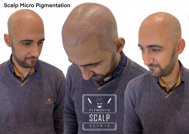 SMP Treatment in Plymouth Sevon